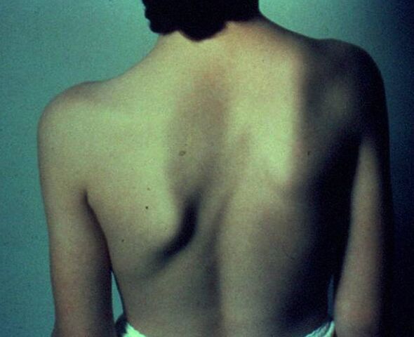 Maladie de Sprengel comme cause de douleur sous l'omoplate gauche