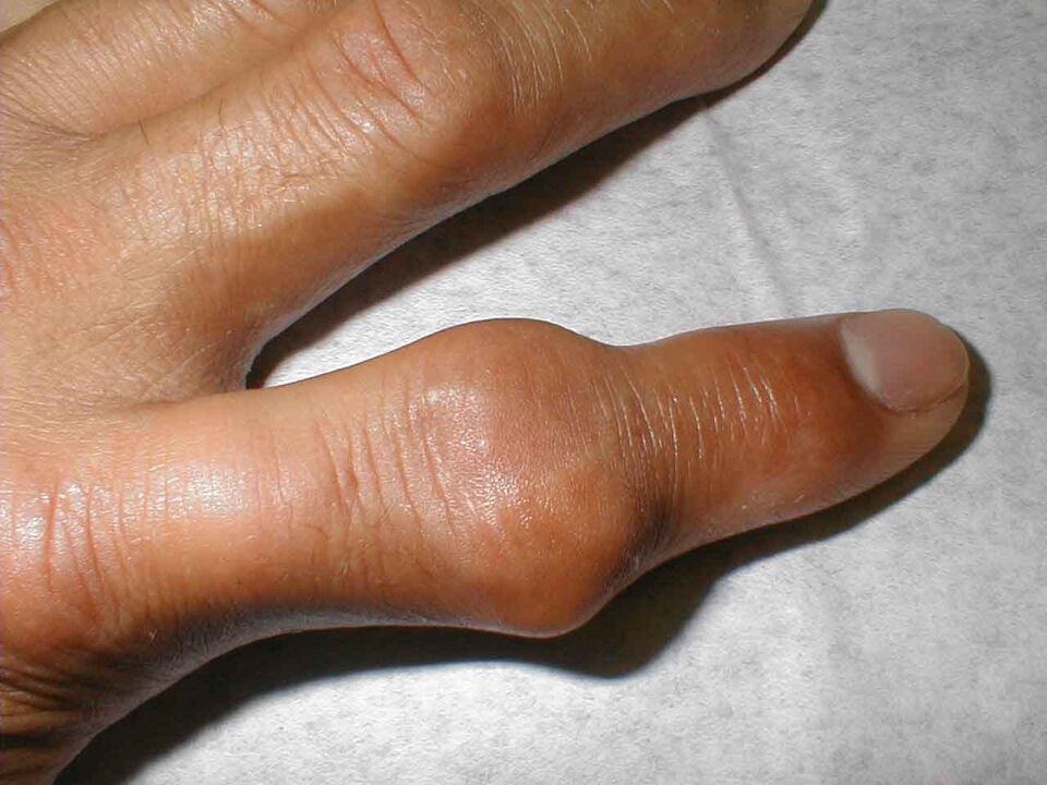 Tophi dans l'articulation du doigt comme cause de douleur